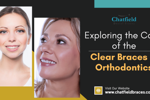 Exploring the Costs of the Clear Braces in Orthodontics clear braces in London