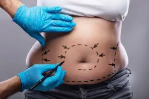 liposuction islamabad