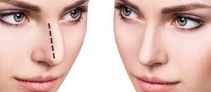 rhinoplasty in pakistan