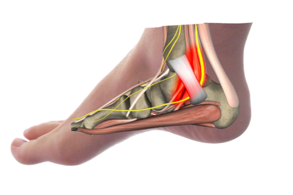 Tarsal Tunnel Syndrome Causes and Treatments in Edinburgh Tarsal Tunnel Syndrome Causes and Treatments in Edinburgh