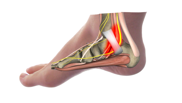 Tarsal Tunnel Syndrome Causes and Treatments in Edinburgh